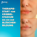 ZOVIRAX Lippenherpes Creme